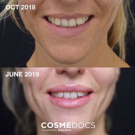 Upper Lip Botox Before And After
