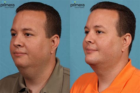 Buccal Fat Removal Before And After Pictures Case 73 Orlando Florida