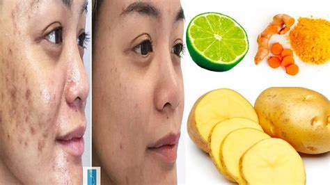 4 Easy Ways To Get Rid Acne Scars Fast At Home Reduce Acne Scare