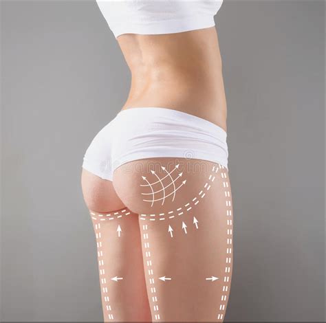 Marks On The Women S Buttocks Waist And Legs Before Plastic Surgery