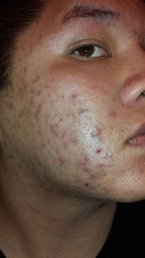 What To Do How Severe Is My Acnepics General Acne Discussion