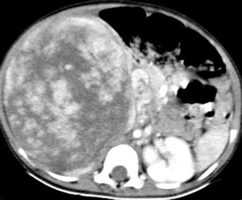 Wilms Tumor Ct Wikidoc