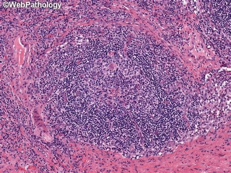 It is a systemic disease that presents with generalized lymphadenopathy, hepatosplenomegaly, constitutional symptoms, skin rash, anemia. Webpathology.com: A Collection of Surgical Pathology Images