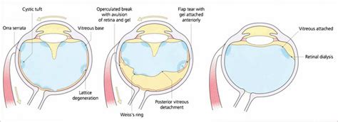 Vitreous And Vitreoretinal Disorders Ento Key