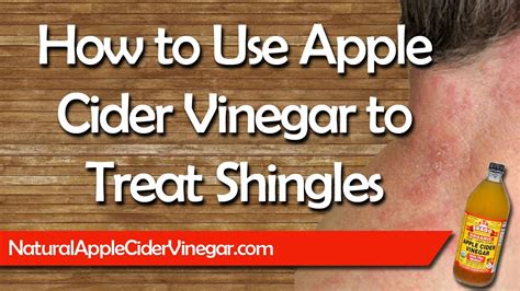 Apple Cider Vinegar For Shingles Natural Home Remedy Treatment Youtube