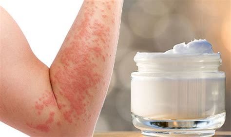 Eczema Cream These Types Of Cream Can Help Soothe Itchy Eczema
