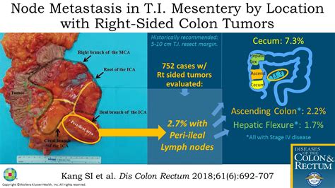Clinical Significance Of Lymph Node Metastasis In The Mesent