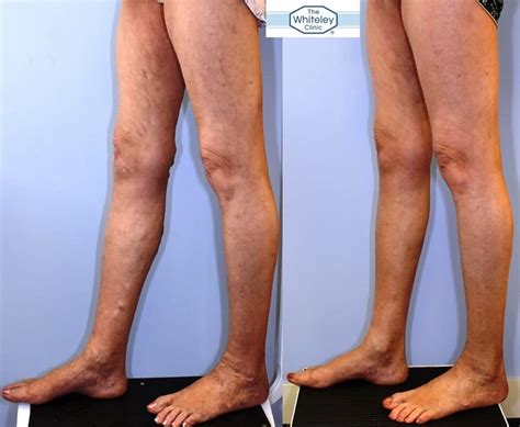 Recurrent Varicose Veins Cured By Whiteley Protocol The Whiteley Clinic