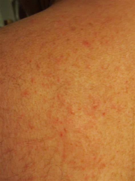 Levaquin Usage Prednisone Treatment And Rash That Comes And