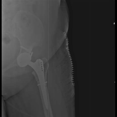 Schematic Picture Of The Steps Of The Subtrochanteric Z Osteotomy