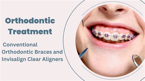Orthodontic Treatment Conventional Orthodontic Braces And Invisalign Clear Aligners Arya