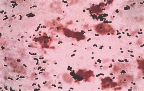 Streptococcus Agalactiae Férfiaknál