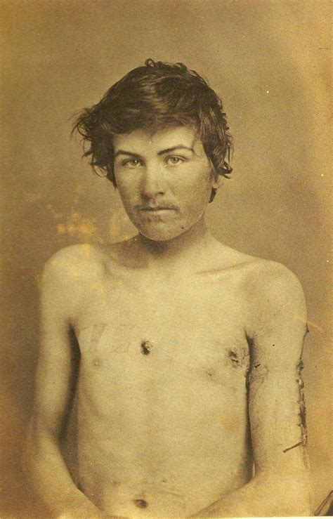 Wounded Civil War Soldiers