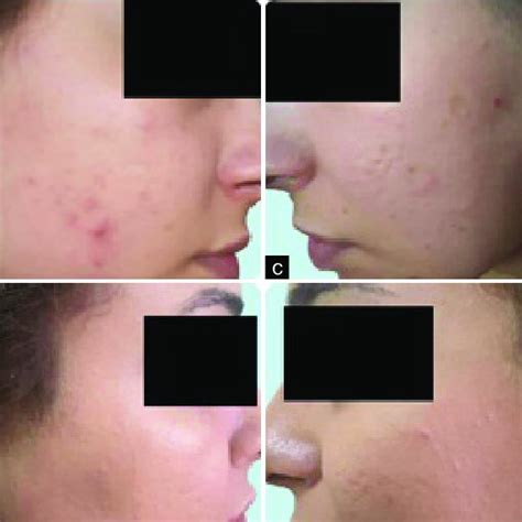 A 28 Year Old Patient With Acne Vulgaris A And C Before Treatment