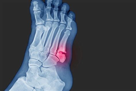 Jones Fracture What Should You Do Sport Doctor London