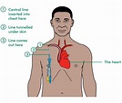 Picc Line Placement Location | Images and Photos finder