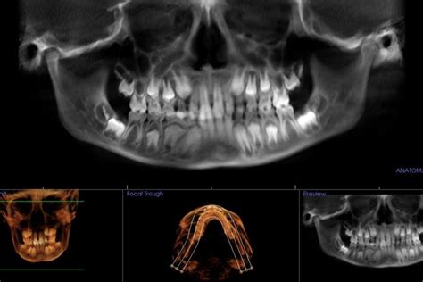 Cone Beam Ct Imaging Springfield Mo Dentist Buzbee Dental