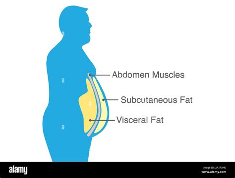 Visceral Fat And Subcutaneous Fat That Accumulate Around Your Waistline Illustration About