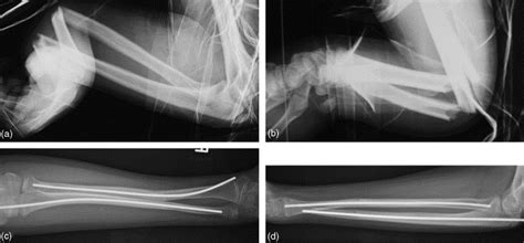 Flexible intramedullary nailing of displaced diaphyseal ...