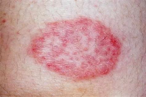 Tiny Pinpoint Red Dots On Skin Caused By Viruses Plansxoler