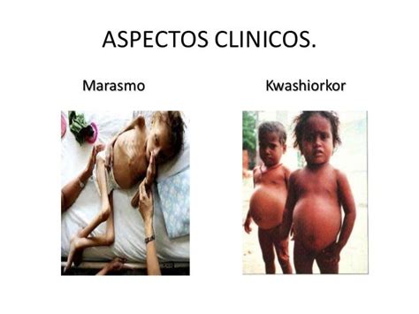 Desnutricion Marasmokwashiorkor Obesidad En Pediatria