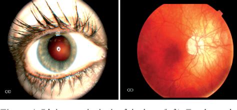 Figure From Ocular Complications Of Marfan Syndrome Report Of Two