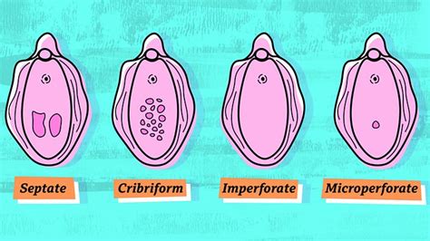 Hymen Abnormalities Using My First Tampon Put Me In Aande Bbc Three