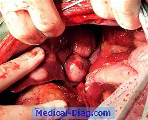 Vulva Krebs Ursachen Symptome Und Behandlungen Medical Diag