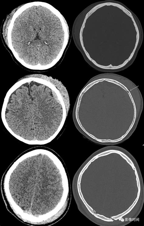 顱腦外傷的急診 CT 表現 - 每日頭條