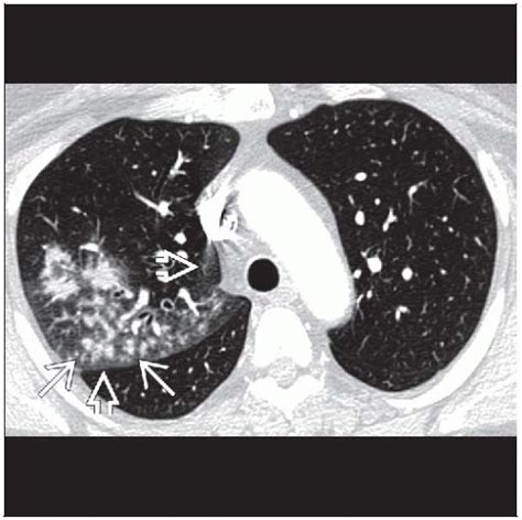 Community Acquired Pneumonia Radiology Key