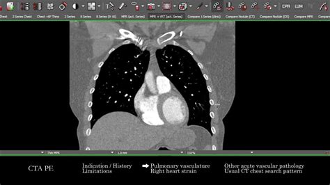 Ct Cta For Pulmonary Embolism Search Pattern Youtube