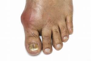 Patient-Reported Gout Attack Intensity Score May Be Reliable for Use in Clinical Studies ... Gout  