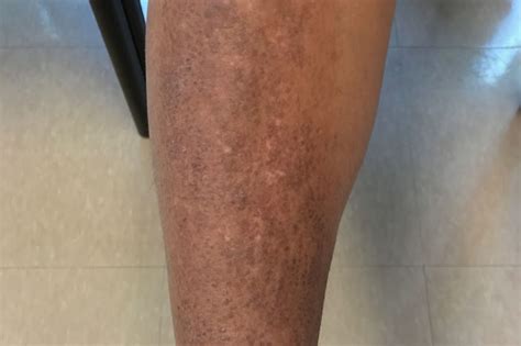 Quiz A Pruritic Rash And Rippled Plaques On A Womans Shin Clinical