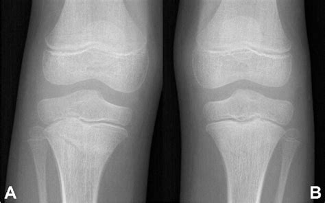 Figure 2 From Bilateral Trampoline Fracture Of The Proximal Tibia In A