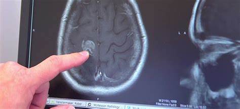 Глиома головного мозга (доброкачественная и злокачественная глиальная Картинка - Глиома головного мозга (доброкачественная и злокачественная глиальная