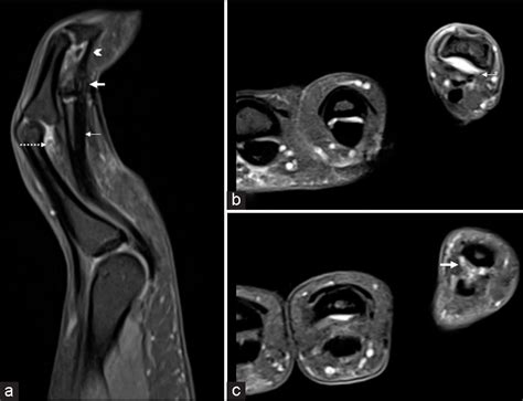 T MRI Of Finger Pulleys Review Of Anatomy And Traumatic Conditions Involving Them Indian