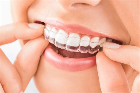 The Main Benefits Of Using Invisible Braces For Your Teeth