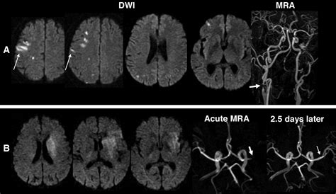 Managing children with cerebralpalsy explore best practice in managing cerebralpalsy powered by physiopedia start course presented by. Lesion Patterns and Stroke Mechanism in Atherosclerotic ...