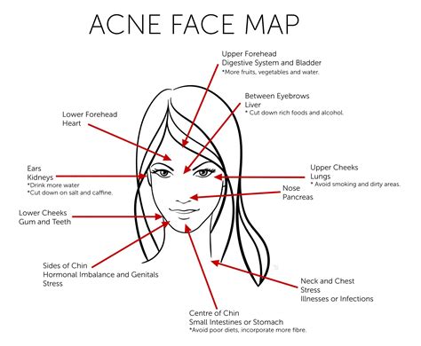 Acne Face Map What Acne Revealing About Your Health Divine Glowing