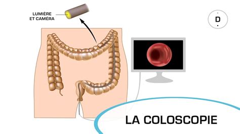 La coloscopie Examens médicaux YouTube