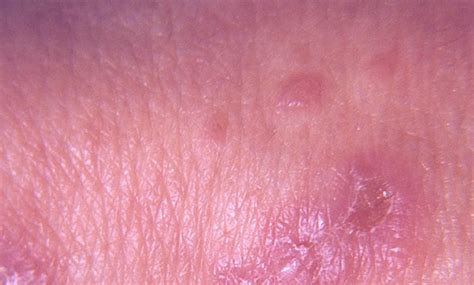 Dermatitis Herpetiformis Pictures Symptoms Causes Treatment Hubpages