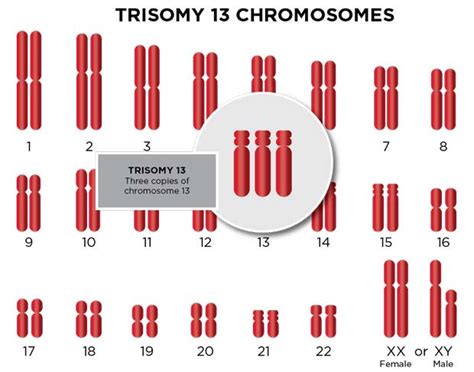 Trisomy 13 Patau Syndrome Types And Diagnosis