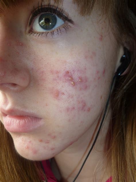 Life On Roaccutane Introduction And My Acne Story So Far Lets Kiss