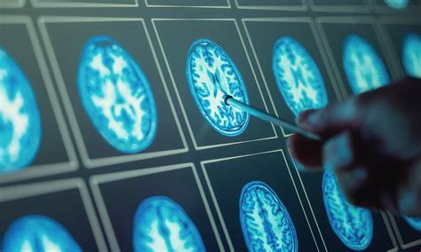 Ai Can Predict Brain Cancer Survival Rate In Patients Suffering From