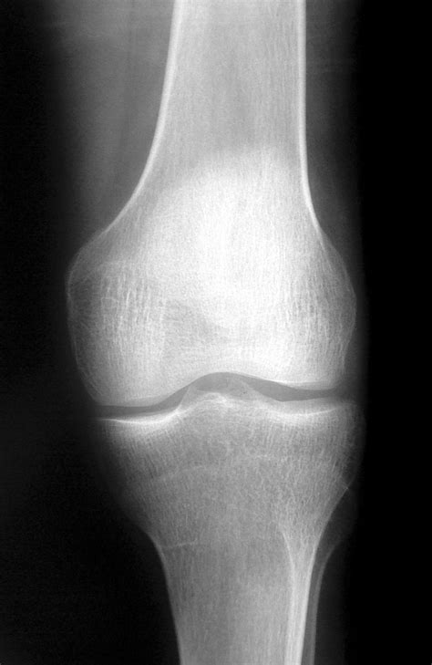 X Rays Forecast Progressive Knee Osteoarthritis