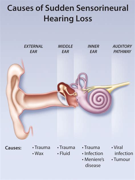 Sudden Sensorineural Hearing Loss Oxygen Oasis