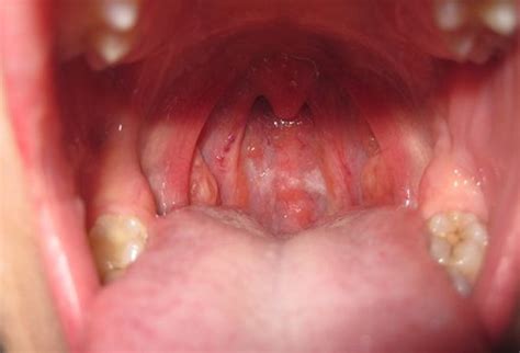 Aching Throat Have You Checked For Tonsil Stones Yet