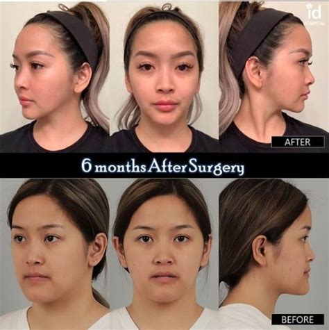 6 Months Difference Before After Orthognathic Double Jaw Surgery In