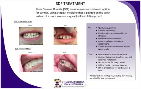 Silver Diamine Fluoride Affiliated Childrens Dental Specialists