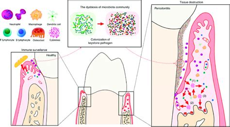 Periodontal Tissue In A Healthy State And The Pathogenesis Of Chronic Download Scientific